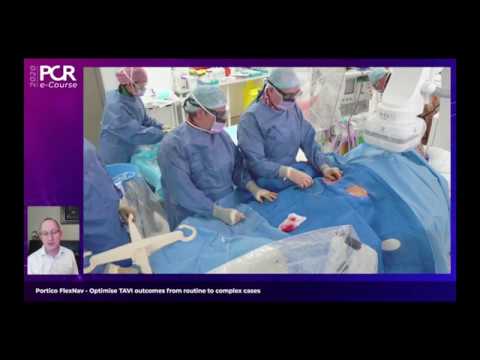 Portico FlexNav - Optimise TAVI outcomes from routine to complex cases