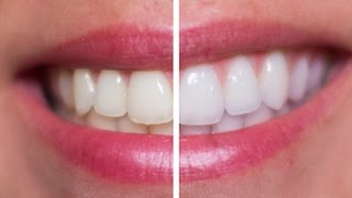 DIY Teeth Whitening Vs. Professional