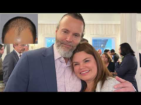 Natural hairline after both FUE and FUT by Dr. Lindsey in McLean, friend of practice | McLean | DC thumbnail
