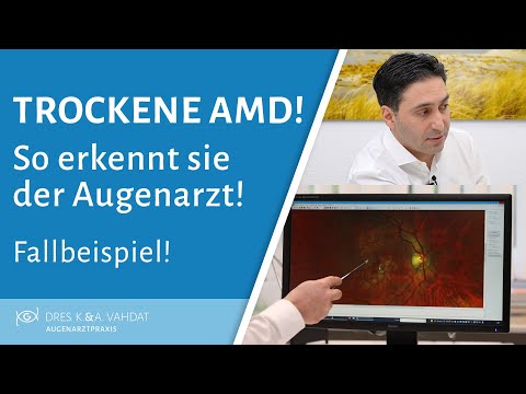 Wie erkennt der Augenarzt eine trockene Makuladegeneration?