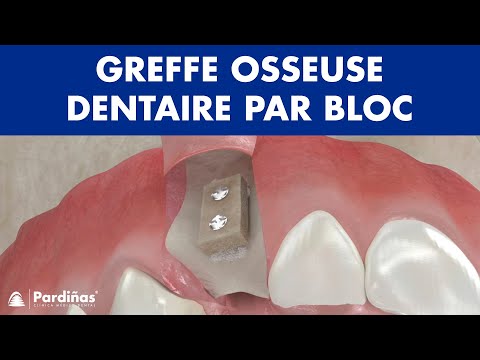 Greffe osseuse dentaire par bloc ©