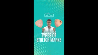 Types of Stretch Marks