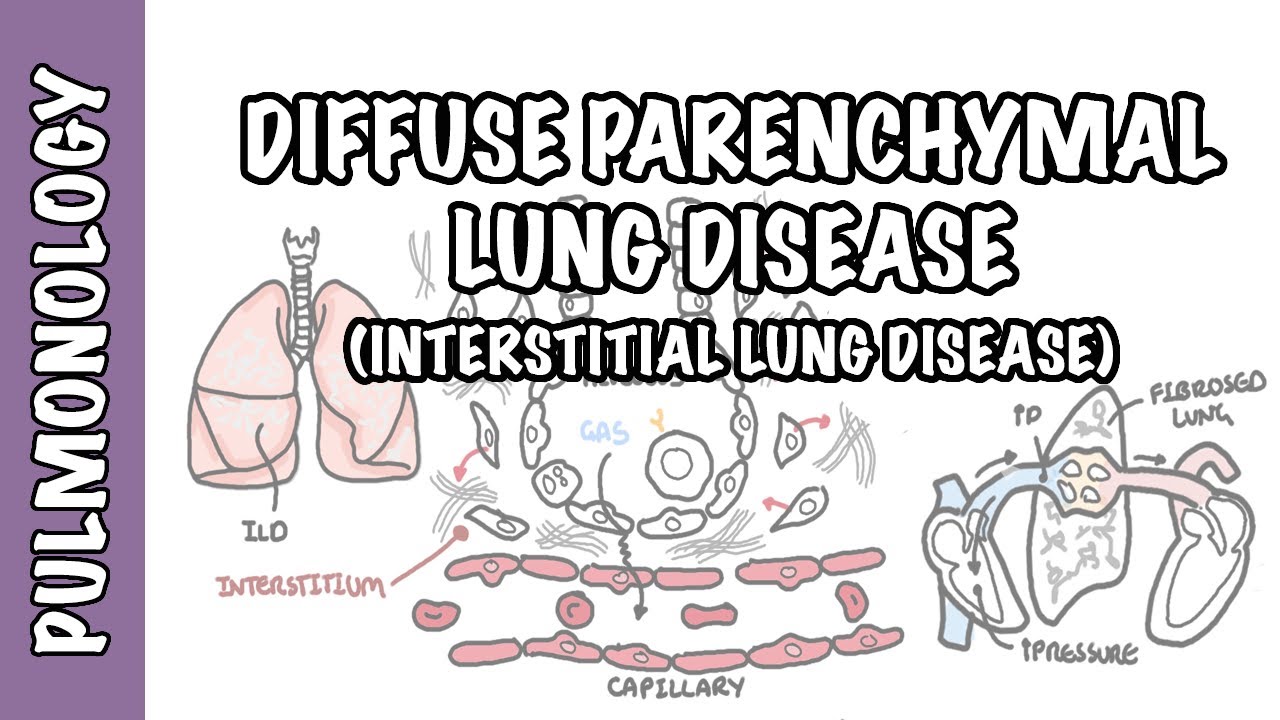 Interstitial Lung Disease (ILD) - Classification, pathophysiology, signs and symptoms