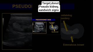 Target, donut,pseudo kidney, sandwich signs of intussception on ultrasound