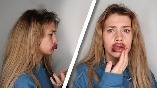 She got BOTCHED LIP FILLER!
