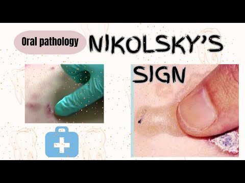 Nikolsky's sign|understanding terms in dentistry|oral pathology|#dental #oralpathology #video #exams