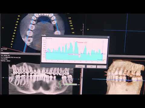 Access patient's bone density, periodontal issues and suitability for a dental implant