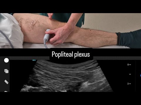 Popliteal plexus - Motorsparing block for TKA - alternative to IPACK -Ultrasound regional anesthesia