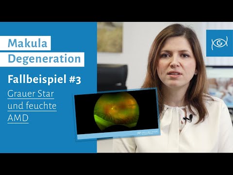 Augenerkrankung Makula Degeneration | Fallbeispiel | Grauer Star und feuchte AMD - Vorsicht nach OP!