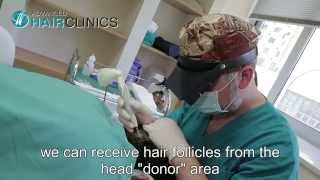 Unshaven FUE in Athens, GREECE - The TOP Hair Transplant destination