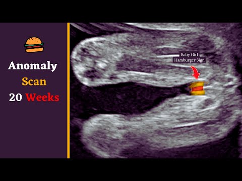 Anomaly Scan at 20 Weeks | Baby Girl Gender