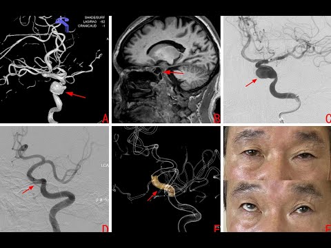 Intrakranielles infektiösen Aneurysmas bei Streptococcus constellatus Infektion