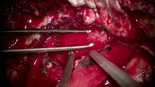 Download Lagu Temporal base meningioma. Thumbnail
