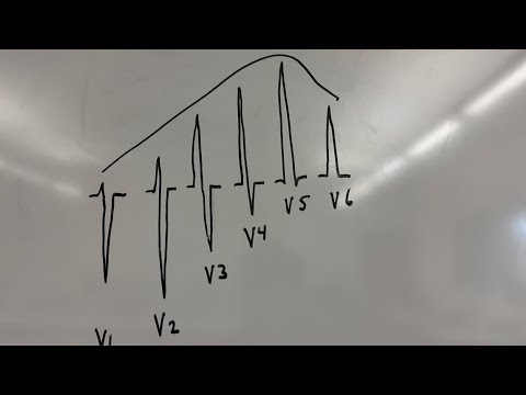 What is R wave progression?