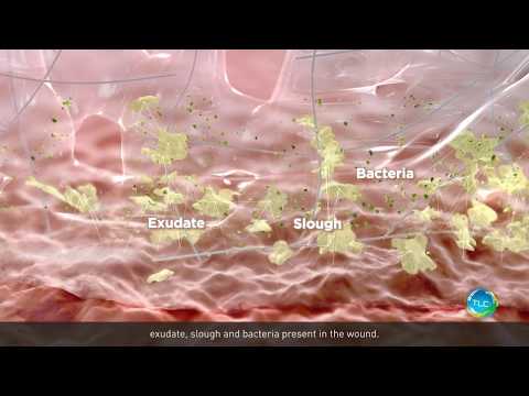 UrgoCleanAg Continuous Debridement