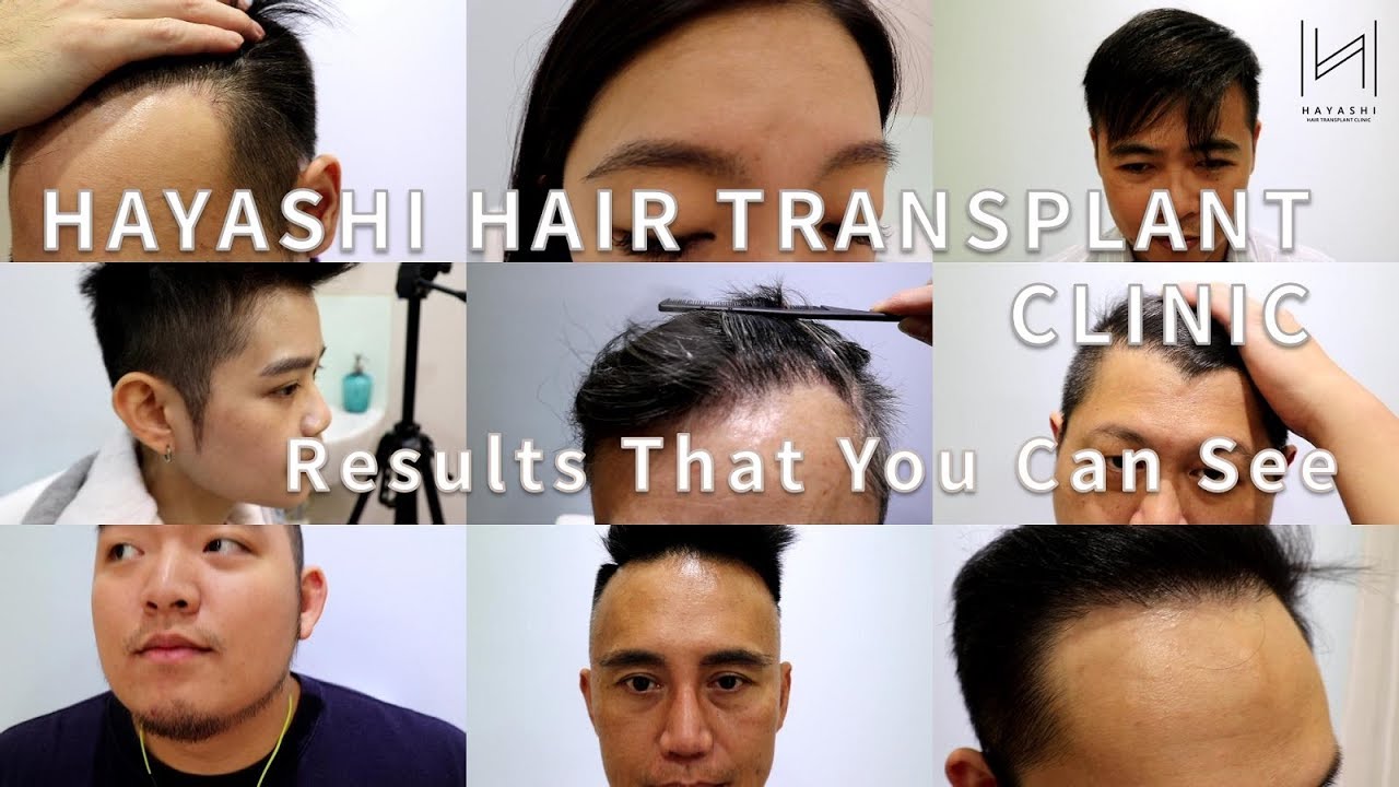 Hayashi Hair Transplant Clinic - Taipei, Taiwan