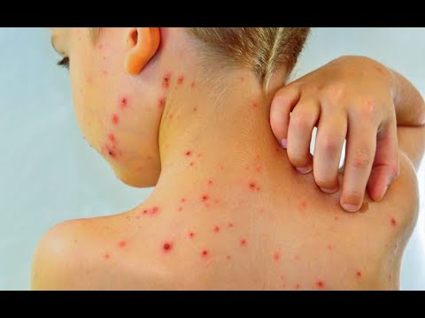 El sarampión es una enfermedad prevenible con la aplicación de vacuna