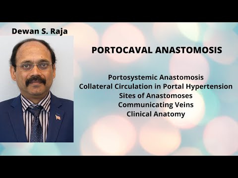 PORTOCAVAL ANASTOMOSIS