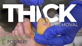 THICKENED Ingrown Removal