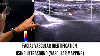 Facial Vascular Identification Using Ultrasound (Vascular Mapping)