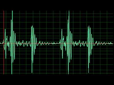 S4 Gallop- normal speed