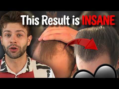 Reddit Minoxidil