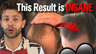 This is How These Reddit Users Finally Regrew Their Hair
