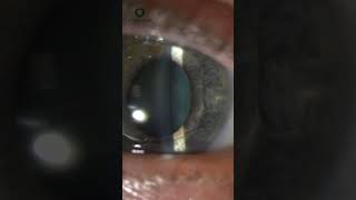 Iris Claw Lens Implant