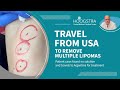Alexia Travel From USA To Remove Lipomas With Laser 25168