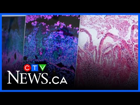 New AI analysis leads to scientific breakthrough in treatment of Crohn’s disease