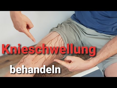 Knee swelling: Perform lymphatic drainage of the knee YOURSELF (Physio shows IMMEDIATE EXERCISE)