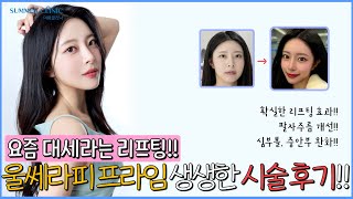 울쎄라 후기, v라인, 리프팅