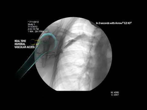 Arrow® EZ-IO® System - Proximal Humerus Infusion Fluoroscopy (Adult, Alert Patient)