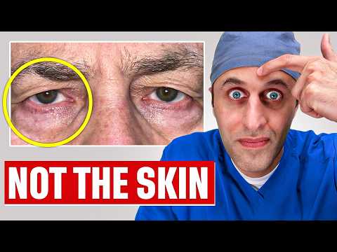 Hooded Eyes? Surgeon Explains REAL Reason (It's Not What you Think)