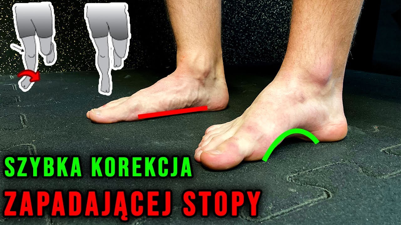 Płaskostopie w ruchu *ćwiczenie korekcyjne* ból stopy i pięty - przyczyna