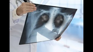 Prophylaxis and Treatment for Pneumocystis Pneumonia