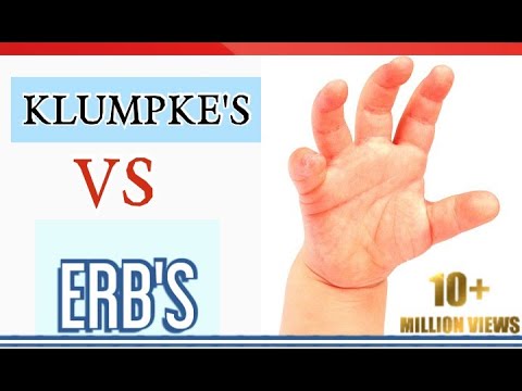 What makes Klumpke's palsy different from Erb's Palsy?