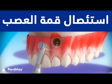 11/12/2023 12:00:00 ص
اسنئصال قمة العصب,,,,,,,, https://www.youtube.com/embed/lhTb1qUz6TI