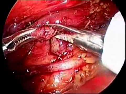 Thoracoscopic Repair of a Type D Tracheoesophageal Fistula