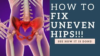 How To Fix Uneven Hips &amp; Tilted Pelvis Muscle Imbalances With These Exercises!