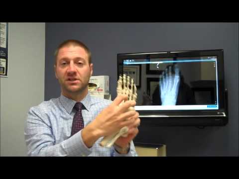 Artroza artrita articulației șoldului