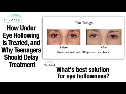 Under Eye Hollowing can be Treated with Fillers, but it does Require Regular Maintenance