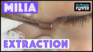 Milium Extraction from a Very Delicate Inner Eye Area
