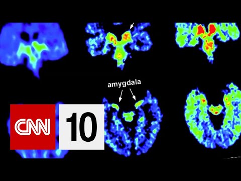 How CTE Can Affect The Brain