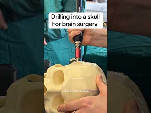 A neurosurgeon drills into the skull for brain surgery. #neurosurgery #medical #doctor #medstudent