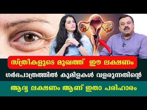 ഹോർമോൺ പ്രശ്നമുള്ള സ്ത്രീകളിൽ കഴുത്തിലെ കറുപ്പ് മാറാനും അനാവശ്യ രോമവളർച്ച മാറാനും
