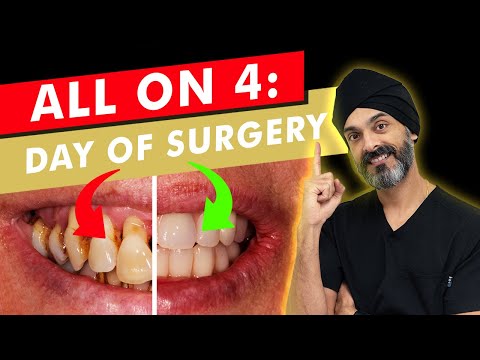 Your Complete Guide to All on 4 Surgery: What to Expect