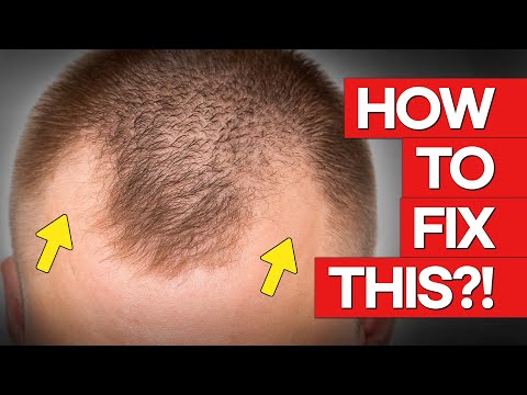 Only ONE solution for M Shaped Hair Loss