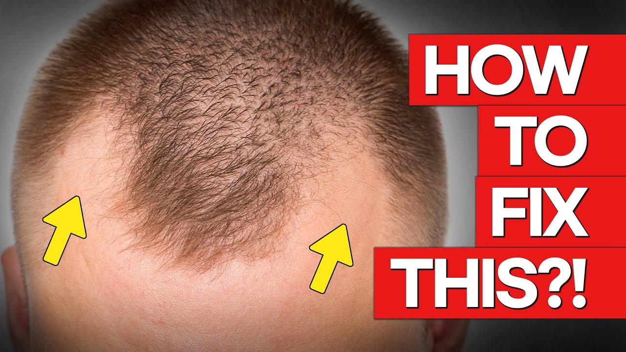 Only ONE solution for M Shaped Hair Loss