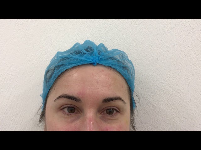 Коррекция морщин ботоксом